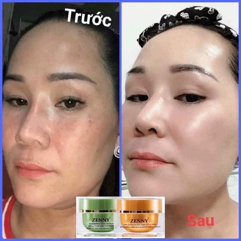 Da của chị trước và sau khi sử dụng kem Face Zenny