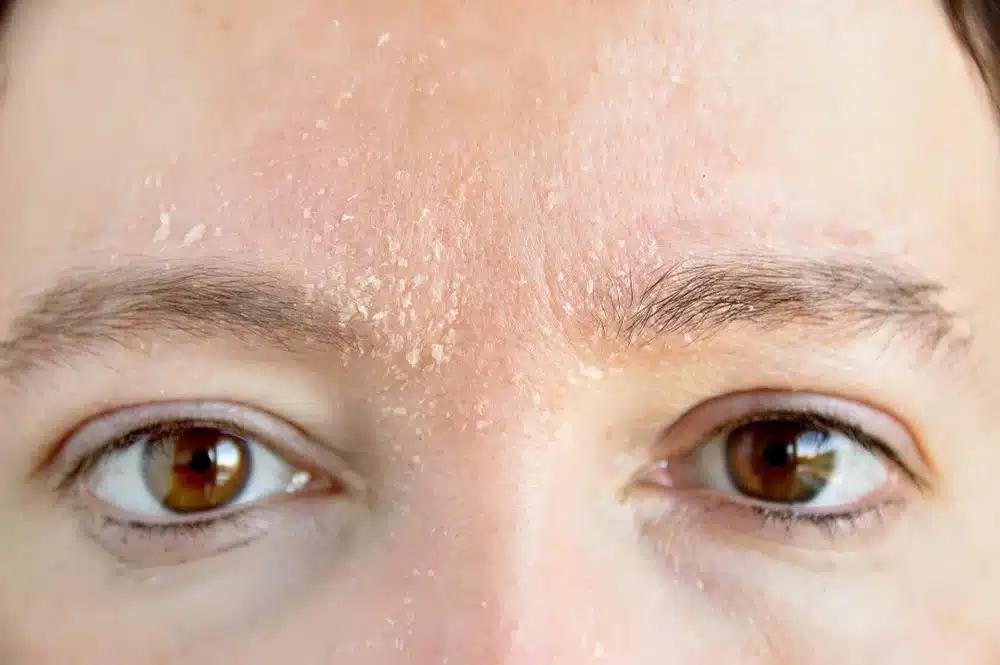 Vùng da mặt thường gặp tình trạng dễ bong tróc và kích ứng vào mùa đông